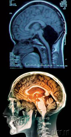 no-cerebellum-in-human-brain